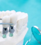 השתלות שיניים – כי האיכות כן קובעת-תמונה